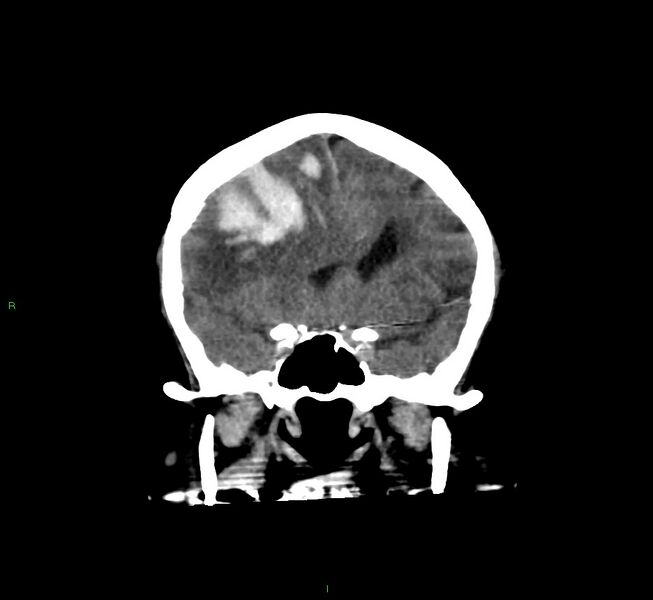 File:Cerebral amyloid angiopathy-associated lobar intracerebral hemorrhage (Radiopaedia 58560-65723 Coronal non-contrast 46).jpg
