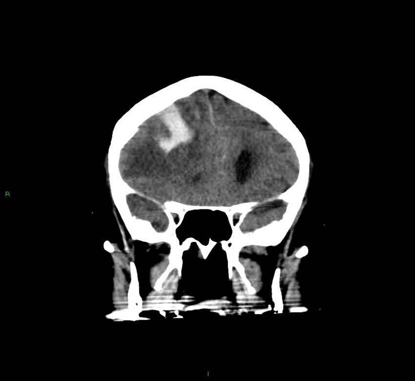 Cerebral amyloid angiopathy-associated lobar intracerebral hemorrhage (Radiopaedia 58560-65723 Coronal non-contrast 49).jpg