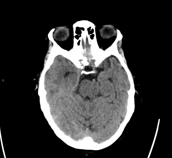 File:Cerebral amyloid angiopathy-associated lobar intracerebral hemorrhage (Radiopaedia 58563-65727 Axial non-contrast 37).jpg