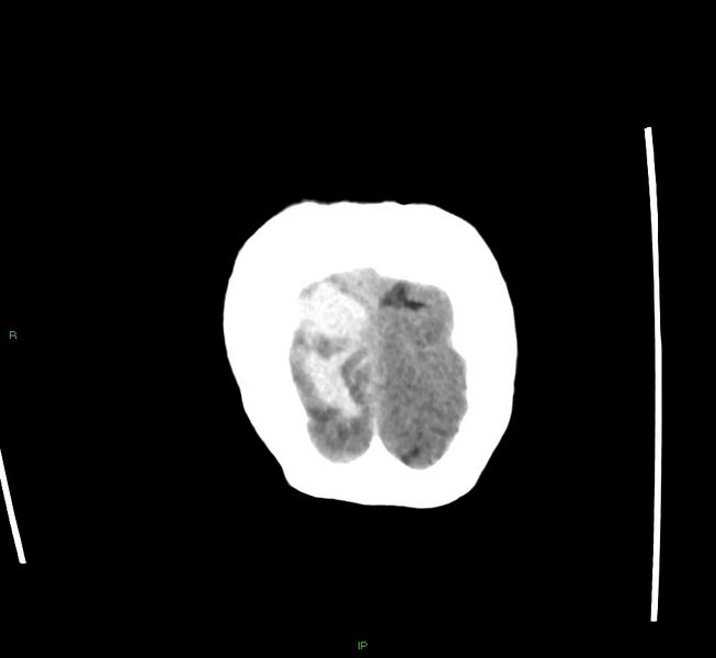 File:Cerebral amyloid angiopathy-associated lobar intracerebral hemorrhage (Radiopaedia 58563-65727 Coronal non-contrast 8).jpg