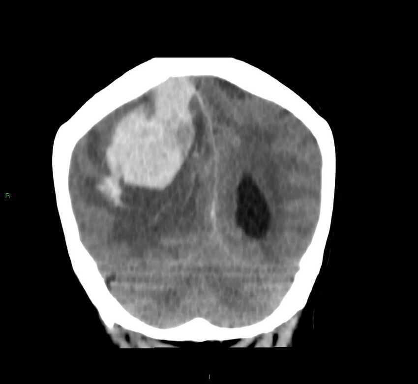 Cerebral amyloid angiopathy-associated lobar intracerebral hemorrhage (Radiopaedia 58751-65972 Coronal non-contrast 19).jpg