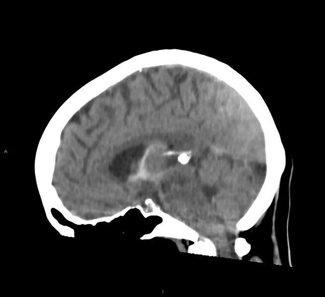 File:Cerebral amyloid angiopathy-associated lobar intracerebral hemorrhage (Radiopaedia 58754-65975 C 23).jpg