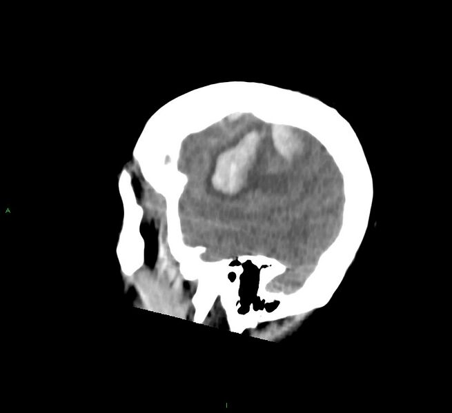 File:Cerebral amyloid angiopathy-associated lobar intracerebral hemorrhage (Radiopaedia 58756-65977 C 12).jpg