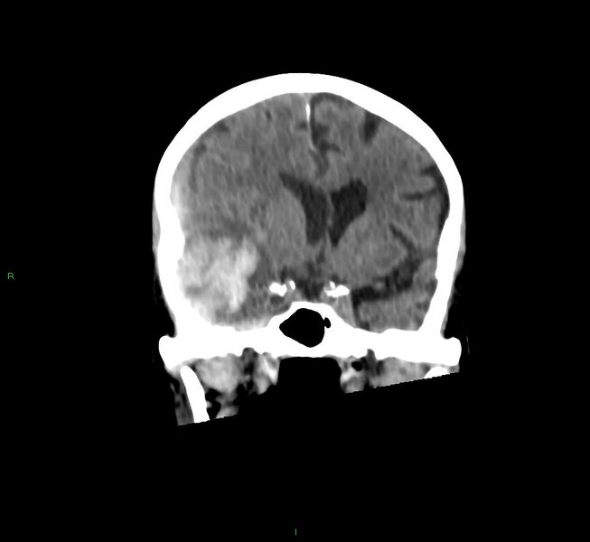 File:Cerebral amyloid angiopathy-associated lobar intracerebral hemorrhage (Radiopaedia 58758-65980 Coronal non-contrast 40).jpg