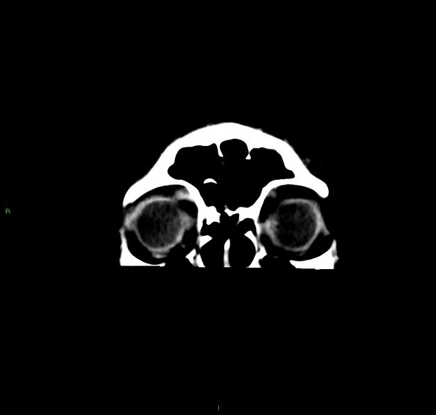 File:Cerebral amyloid angiopathy-associated lobar intracerebral hemorrhage (Radiopaedia 59356-66716 Coronal non-contrast 60).jpg