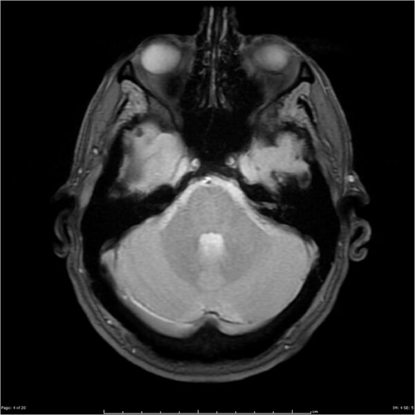 File:Cerebral amyloid angiopathy (Radiopaedia 4561-6683 Axial Gradient Echo 1).jpg