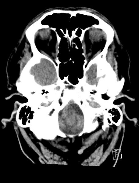 File:Cerebral arteriovenous malformation (Radiopaedia 78188-90745 Axial non-contrast 3).jpg