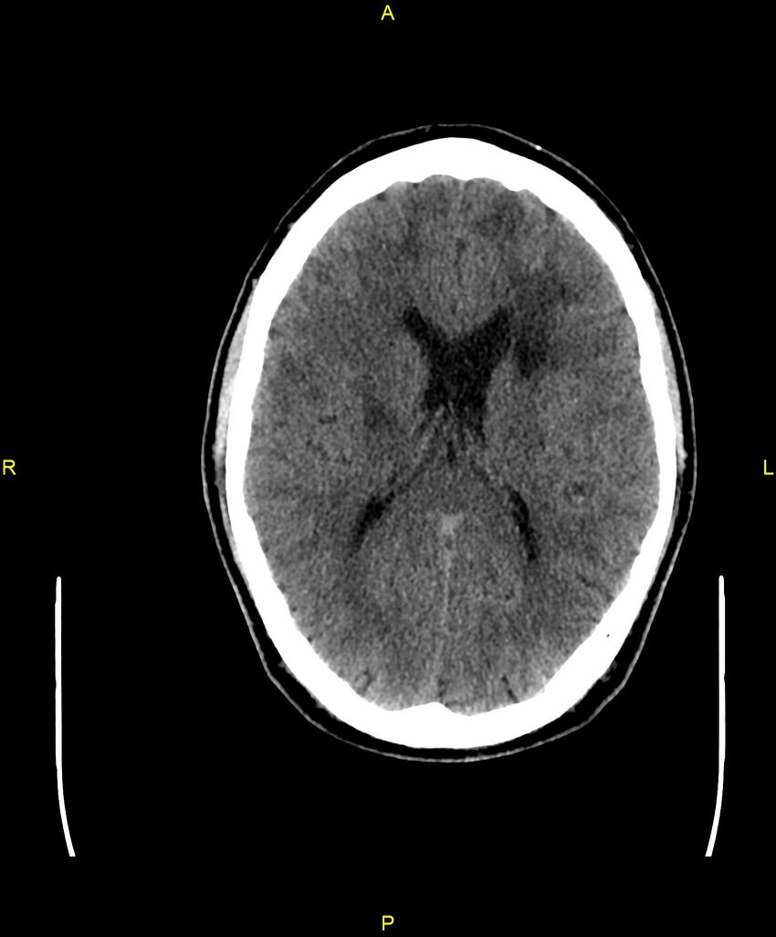 Cerebral autosomal dominant arteriopathy with subcortical infarcts and leukoencephalopathy (CADASIL) (Radiopaedia 86108-102051 Axial non-contrast 63).jpg