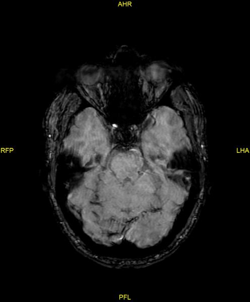 File:Cerebral autosomal dominant arteriopathy with subcortical infarcts and leukoencephalopathy (CADASIL) (Radiopaedia 86108-102054 Axial SWI 38).jpg