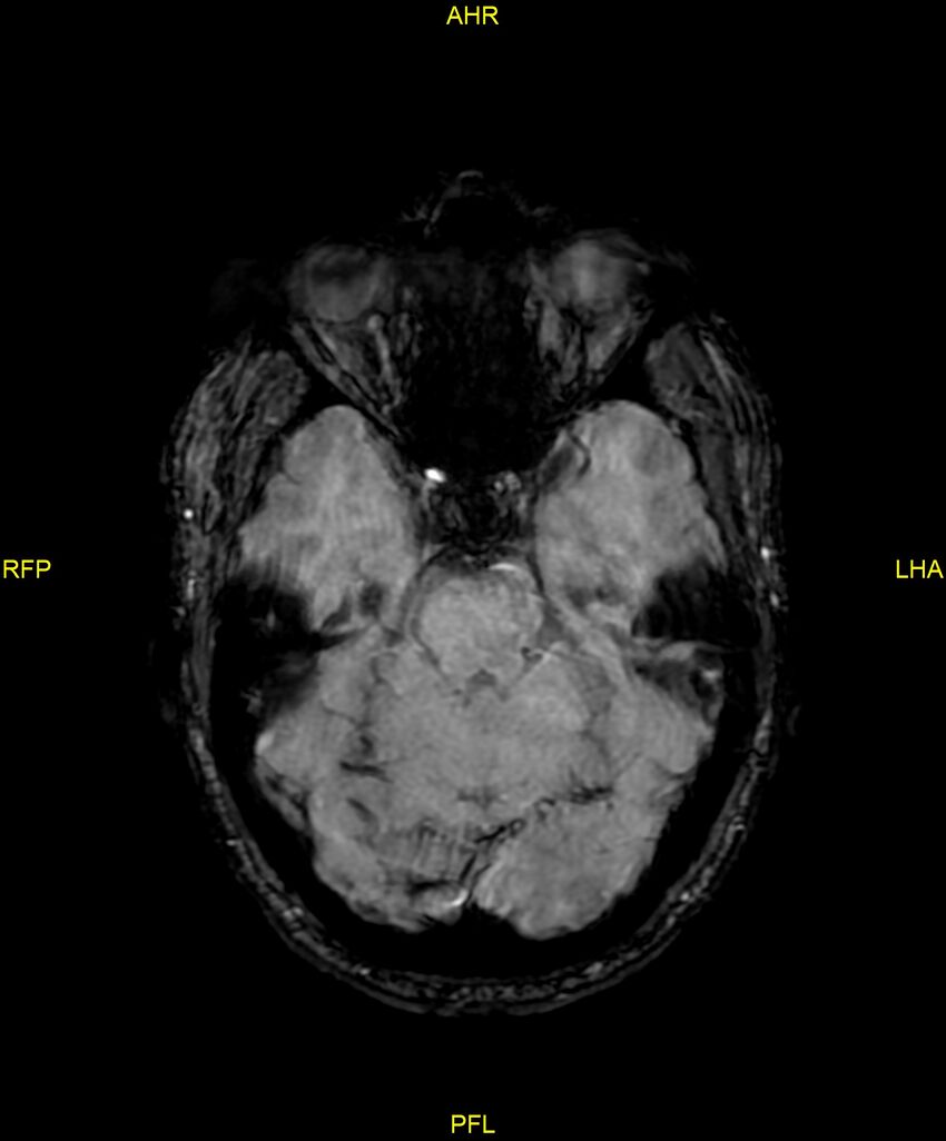Cerebral autosomal dominant arteriopathy with subcortical infarcts and leukoencephalopathy (CADASIL) (Radiopaedia 86108-102054 Axial SWI 38).jpg