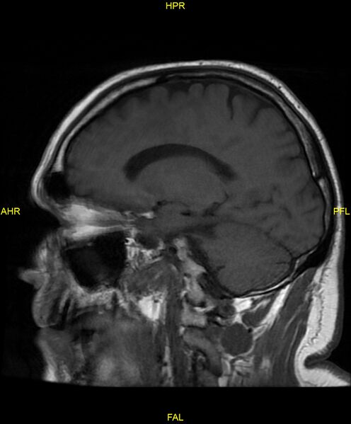 File:Cerebral autosomal dominant arteriopathy with subcortical infarcts and leukoencephalopathy (CADASIL) (Radiopaedia 86108-102054 Sagittal T1 17).jpg