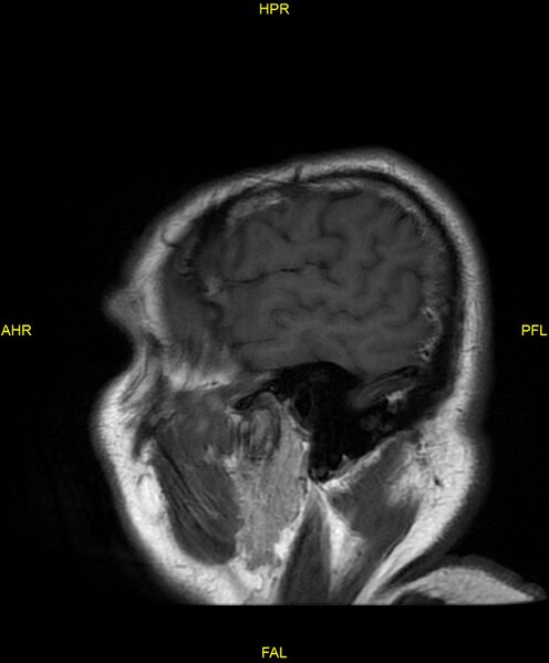 File:Cerebral autosomal dominant arteriopathy with subcortical infarcts and leukoencephalopathy (CADASIL) (Radiopaedia 86108-102054 Sagittal T1 4).jpg