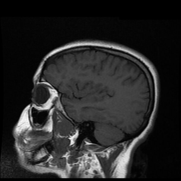 File:Cerebral cavernous malformation (Radiopaedia 44301-47942 Sagittal T1 16).jpg