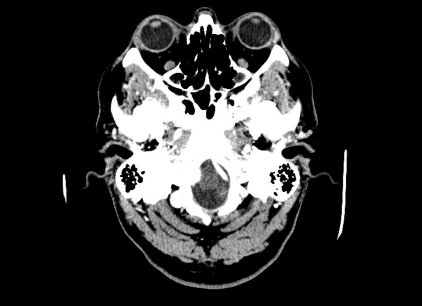 Cerebral edema (Radiopaedia 82519-96661 B 51).jpg