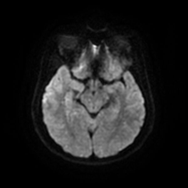 File:Cerebral fat embolism (Radiopaedia 37510-39363 Axial DWI 12).jpg