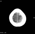 Cerebral hemorrhagic contusion with subdural and subarachnoid hemorrhage (Radiopaedia 10680-11146 Axial non-contrast 25).jpg