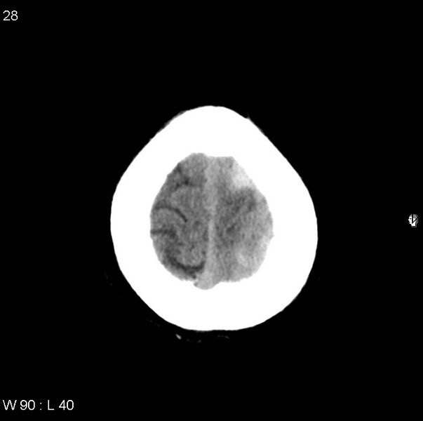 File:Cerebral hemorrhagic contusion with subdural and subarachnoid hemorrhage (Radiopaedia 10680-11146 Axial non-contrast 25).jpg