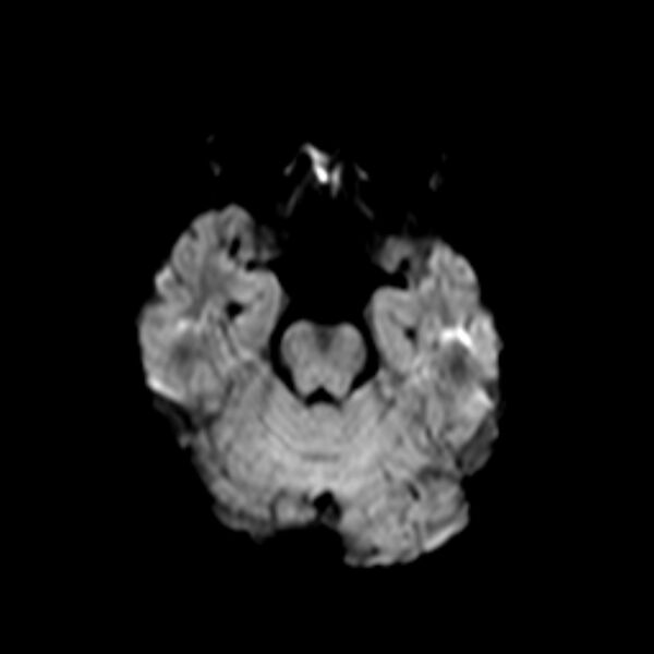 File:Cerebral tuberculoma (Radiopaedia 41152-43932 Axial DWI 6).jpg