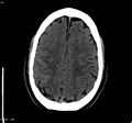 Cerebral vein thrombosis (Radiopaedia 4408-6628 Axial non-contrast 1).jpg