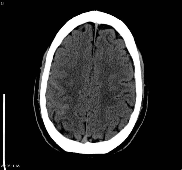File:Cerebral vein thrombosis (Radiopaedia 4408-6628 Axial non-contrast 1).jpg