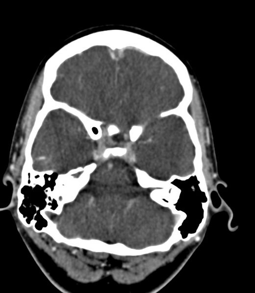 File:Cerebral venous sinus thrombosis (Radiopaedia 59224-66646 Axial C+ delayed 40).jpg
