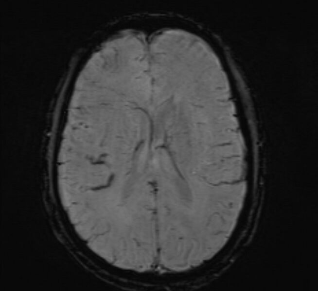 File:Cerebral venous thrombosis (Radiopaedia 71207-81504 Axial SWI 32).jpg