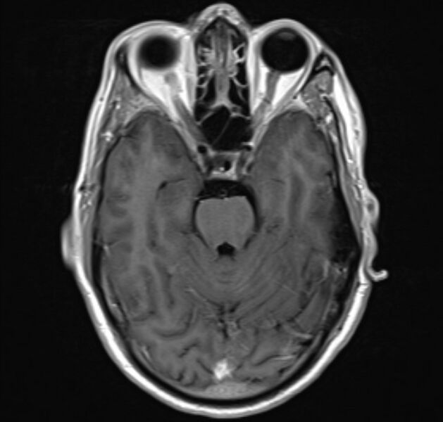 File:Cerebral venous thrombosis (Radiopaedia 71207-81504 Axial T1 C+ 9).jpg