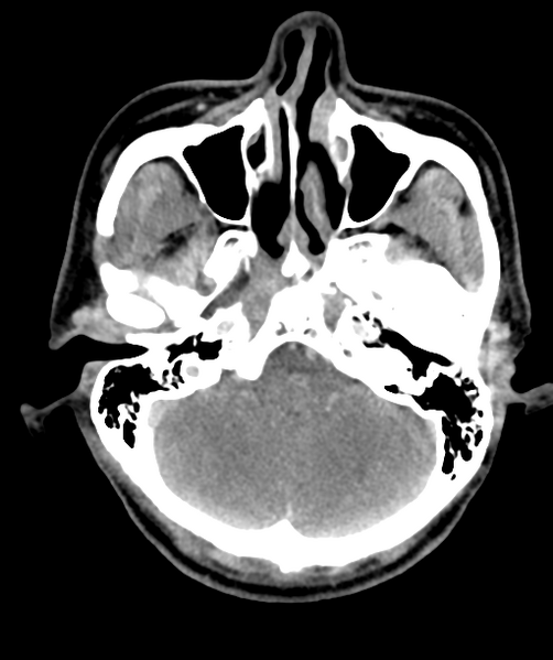File:Cervical abscess (Radiopaedia 43725-47184 A 5).png