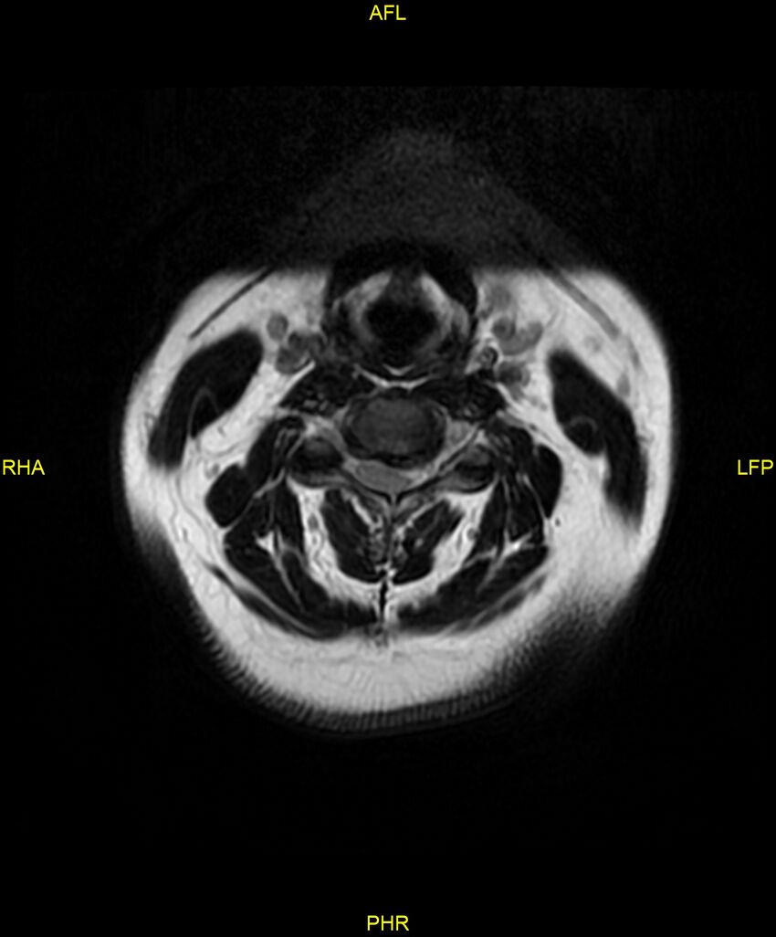 Cervical disc protrusion (Radiopaedia 87147-103415 Axial T2 7).jpg