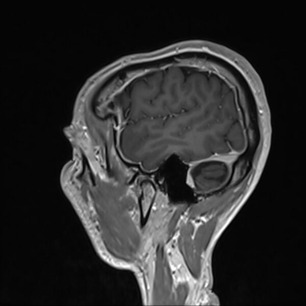 File:Cervical dural CSF leak on MRI and CT treated by blood patch (Radiopaedia 49748-54995 G 107).jpg