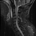 Cervical flexion teardrop fracture with cord hemorrhage (Radiopaedia 32497-33455 Sagittal STIR 11).jpg