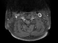 Cervical schwannoma (Radiopaedia 72399-82934 Axial T1 C+ fat sat 5).jpg