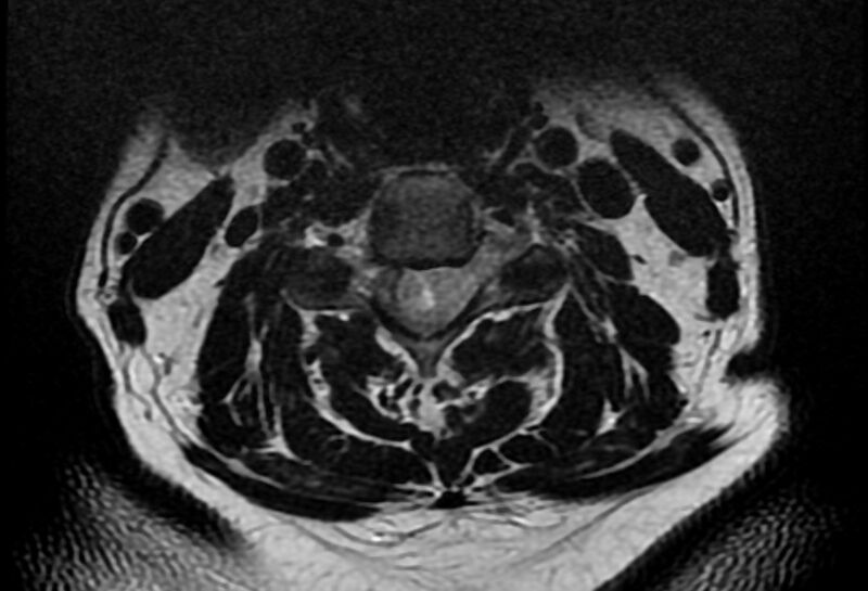 File:Cervical schwannoma (Radiopaedia 72399-82934 Axial T2 9).jpg