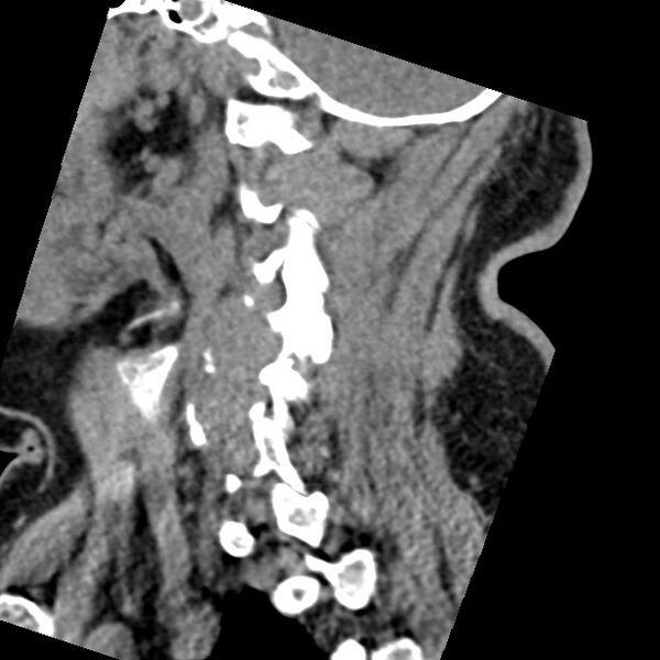 File:Cervical spinal neurofibroma in a patient with NF1 (Radiopaedia 58344-65464 C 14).jpg