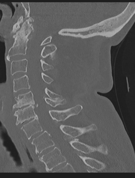 File:Cervical spondylolysis (Radiopaedia 49616-54811 Sagittal bone window 36).png