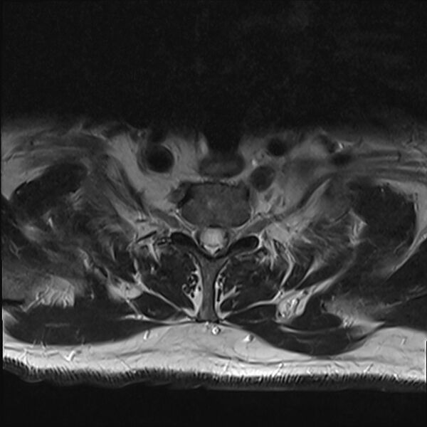 File:Cervical tumor-like myelopathy due to Type V dAVF (Radiopaedia 82461-96604 Axial T2 34).jpg