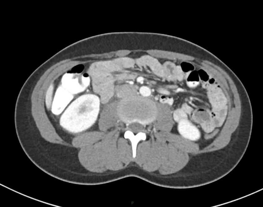 Cesarean scar endometriosis (Radiopaedia 82925-97262 A 42).jpg