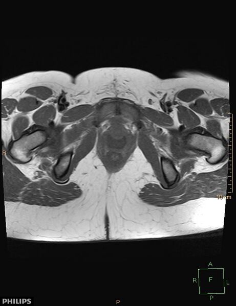 File:Cesarian scar endometriosis (Radiopaedia 68495-78066 Axial T1 23).jpg