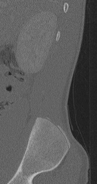 File:Chance fracture (Radiopaedia 40360-42912 Sagittal bone window 91).png