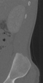 Chance fracture (Radiopaedia 40360-42912 Sagittal bone window 91).png