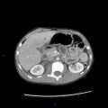Chance fracture with duodenal and pancreatic lacerations (Radiopaedia 43477-46864 A 9).jpg