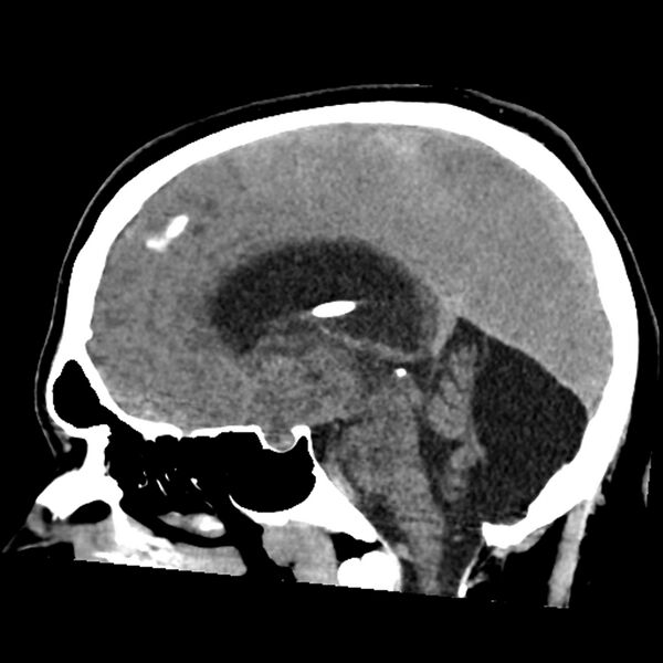 File:Chiasmatic-hypothalamic juvenile pilocytic astrocytoma (Radiopaedia 78533-91237 B 32).jpg