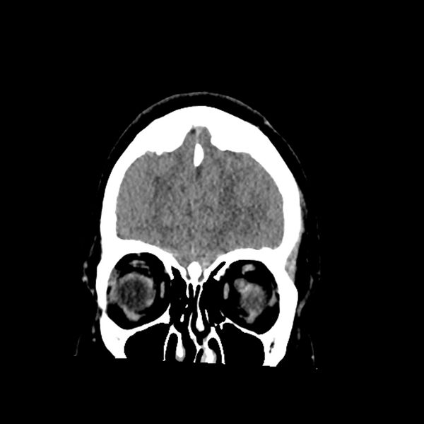 File:Chiasmatic-hypothalamic juvenile pilocytic astrocytoma (Radiopaedia 78533-91237 Coronal non-contrast 15).jpg