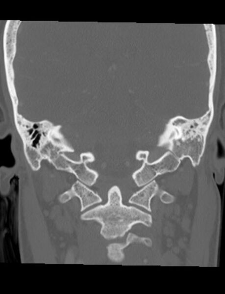 File:Cholesteatoma (pars flaccida) (Radiopaedia 28782-29083 Coronal bone window 7).jpg