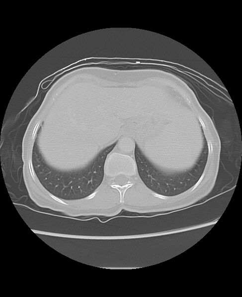 File:Chondrosarcoma (Radiopaedia 79427-92532 Axial lung window 50).jpg