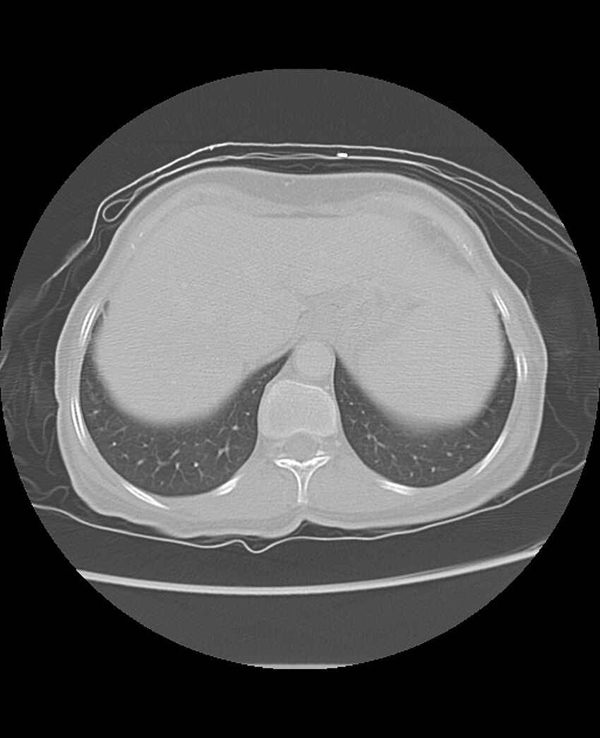 Chondrosarcoma (Radiopaedia 79427-92532 Axial lung window 50).jpg