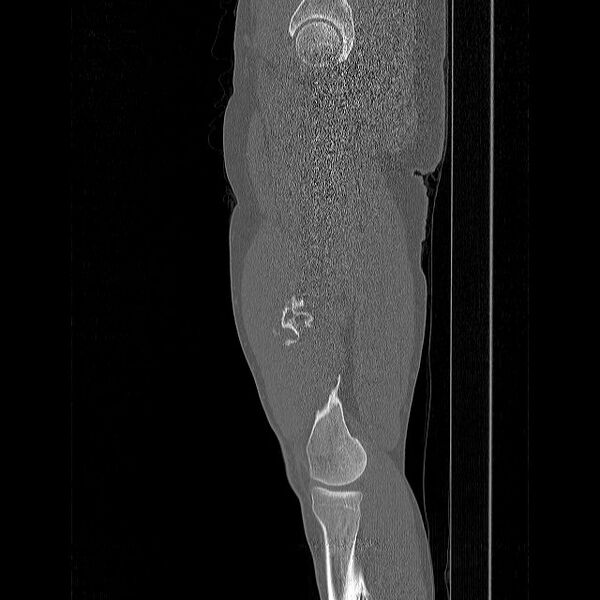 File:Chondrosarcoma arising from exostosis (Radiopaedia 59996-67507 Sagittal bone window 15).jpg