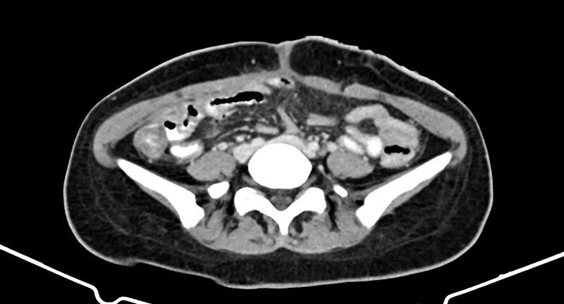 File:Choriocarcinoma liver metastases (Radiopaedia 74768-85766 A 138).jpg