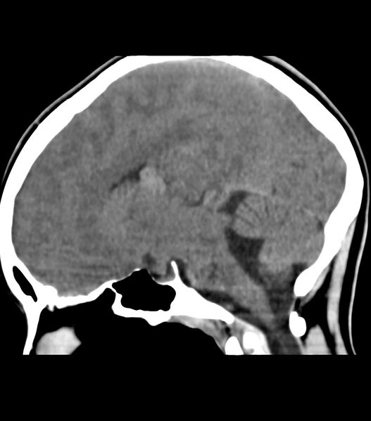 File:Choroid plexus carcinoma (Radiopaedia 91013-108552 B 37).jpg