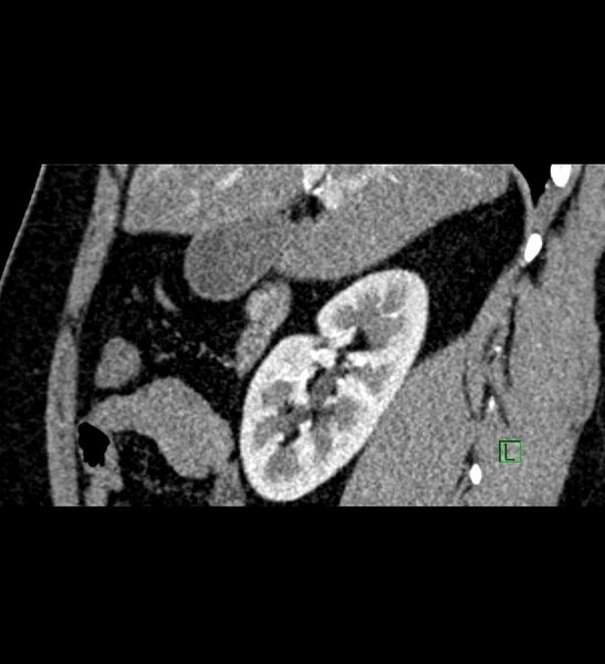 File:Chromophobe renal cell carcinoma (Radiopaedia 84286-99573 F 116).jpg